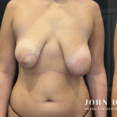 Breast Augmentation with Breast Lift before and after - before