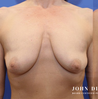Breast Augmentation with Breast Lift before and after - before
