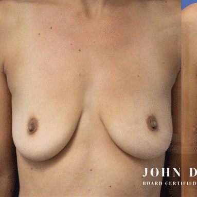 Breast Augmentation with Breast Lift before and after - before