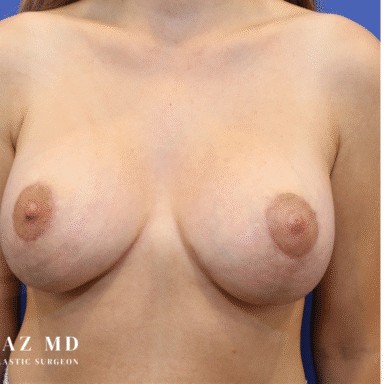 Breast Augmentation with Breast Lift before and after - after