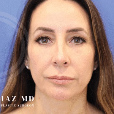 Blepharoplasty before and after - after