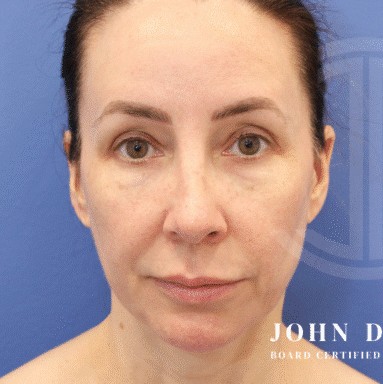Blepharoplasty before and after - before