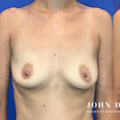 Breast Augmentation with Breast Lift before and after - before