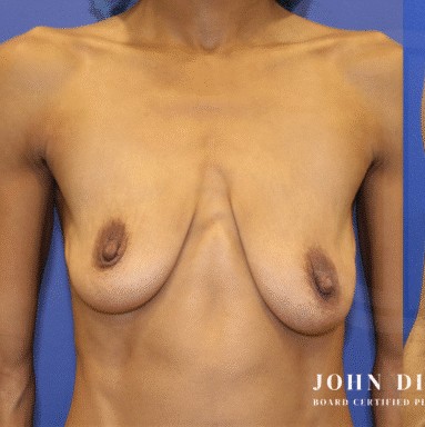 Breast Augmentation with Breast Lift before and after - before