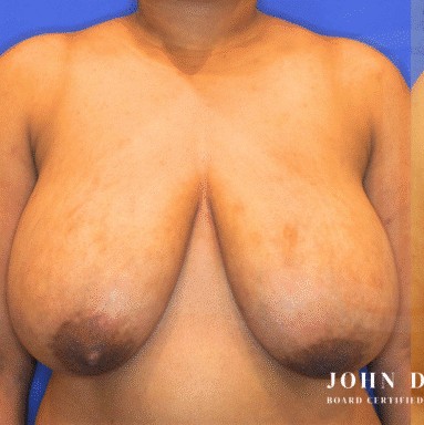 Breast Augmentation with Breast Lift before and after - before