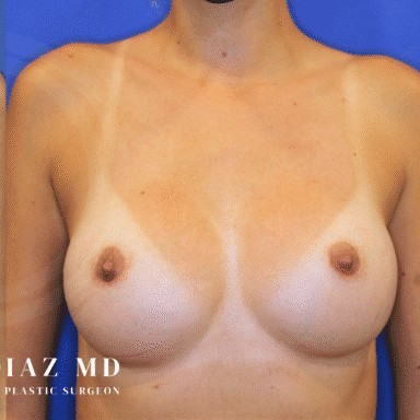 Breast Revision before and after - after