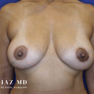 Breast Revision before and after - after
