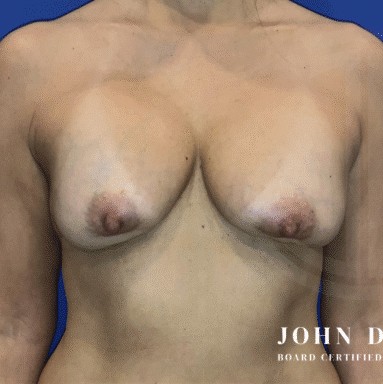 Breast Revision before and after - before
