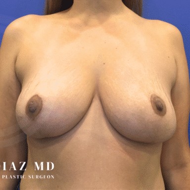 Breast Revision before and after - after
