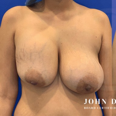Breast Revision before and after - before