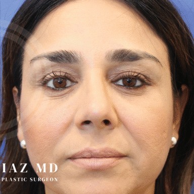 Blepharoplasty before and after - after