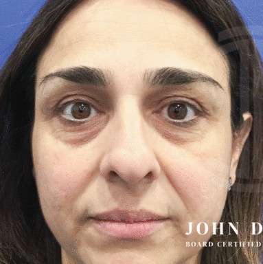 Blepharoplasty before and after - before
