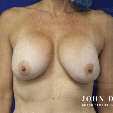 Breast Revision before and after - before