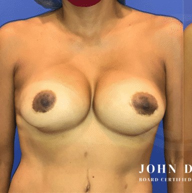 Breast Revision before and after - before