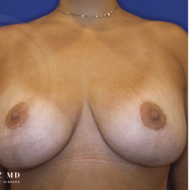 Breast Revision before and after - after