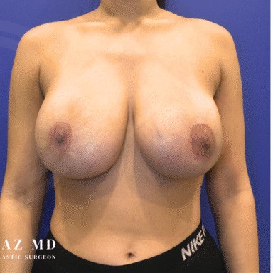 Breast Revision before and after - after