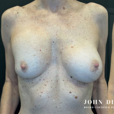 Breast Revision before and after - before