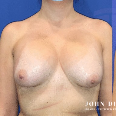 Breast Revision before and after - before