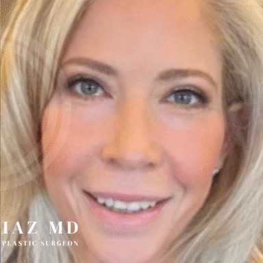Blepharoplasty before and after - after
