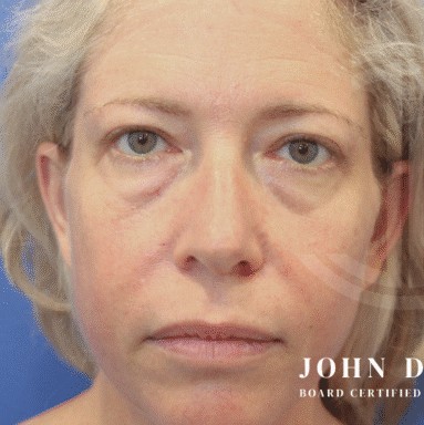 Blepharoplasty before and after - before