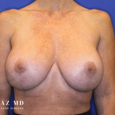 Breast Revision before and after - after