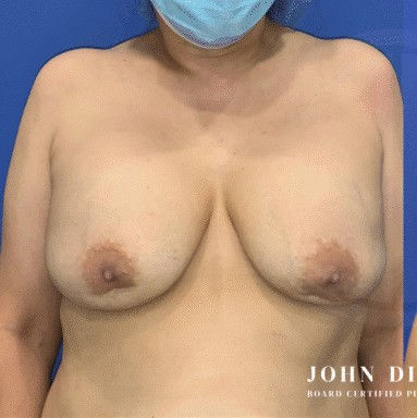 Breast Revision before and after - before