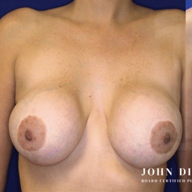 Breast Revision before and after - before