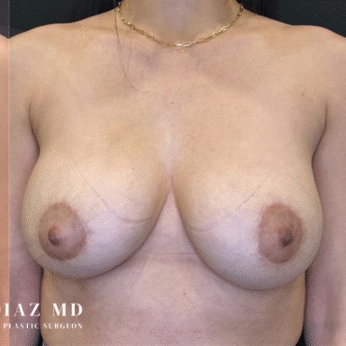 Breast Revision before and after - after