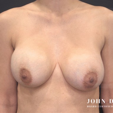 Breast Revision before and after - before
