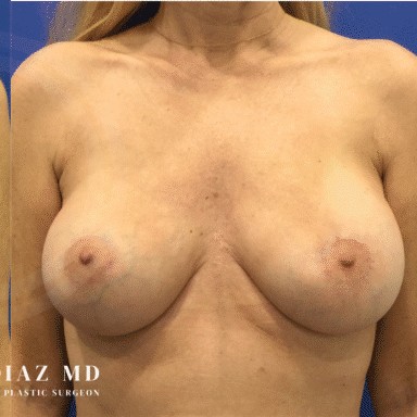 Breast Revision before and after - after