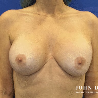 Breast Revision before and after - before