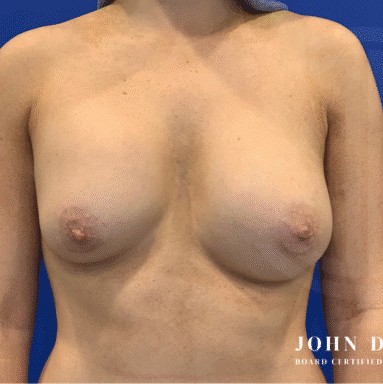Breast Revision before and after - before