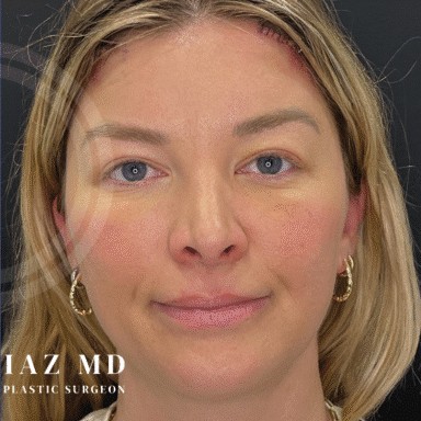 Blepharoplasty before and after - after