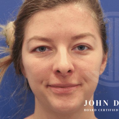 Blepharoplasty before and after - before