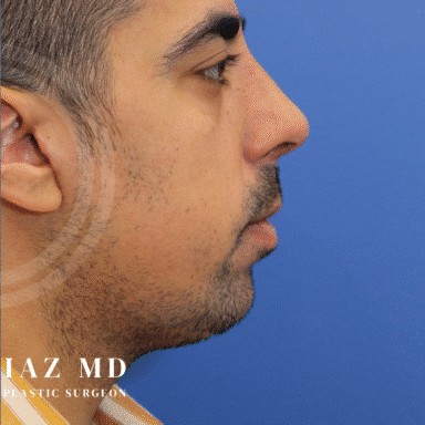 Chin Augmentation before and after - after