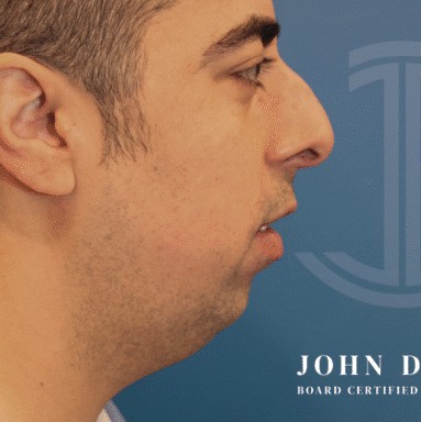 Chin Augmentation before and after - before