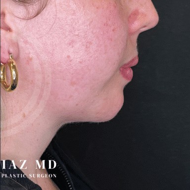 Chin Augmentation before and after - after