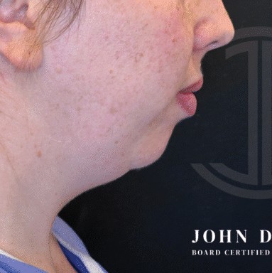 Chin Augmentation before and after - before