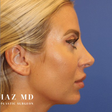 Chin Augmentation before and after - after