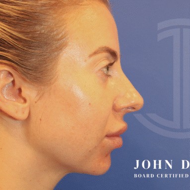 Chin Augmentation before and after - before