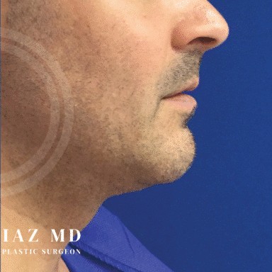 Chin Augmentation before and after - after