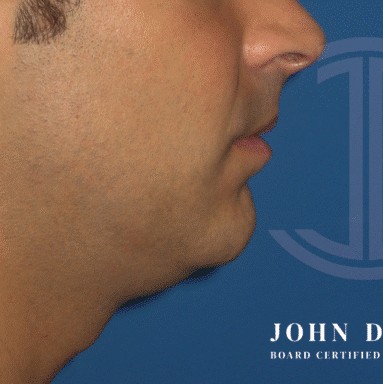 Chin Augmentation before and after - before