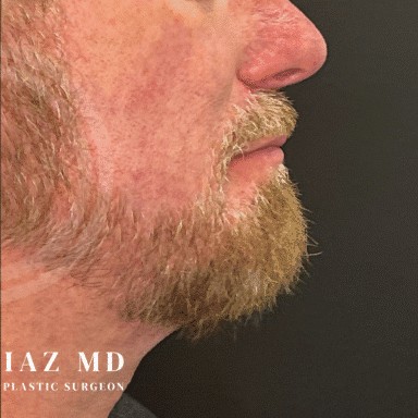 Chin Augmentation before and after - after