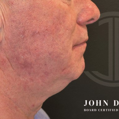 Chin Augmentation before and after - before