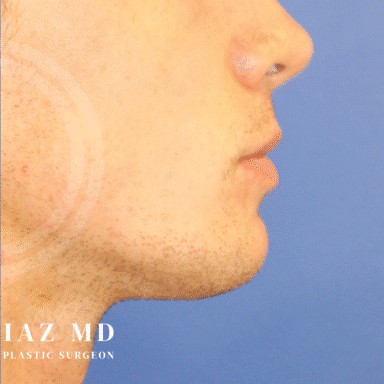 Chin Augmentation before and after - after