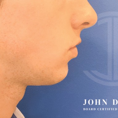 Chin Augmentation before and after - before