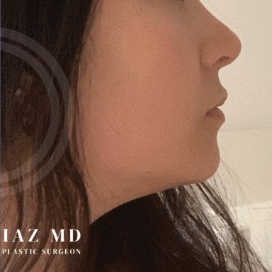 Chin Augmentation before and after - after