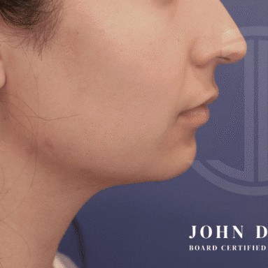 Chin Augmentation before and after - before