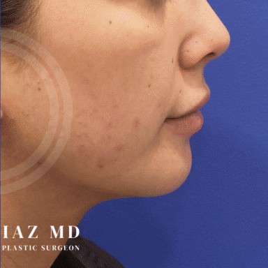 Chin Augmentation before and after - after