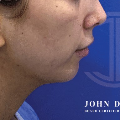 Chin Augmentation before and after - before